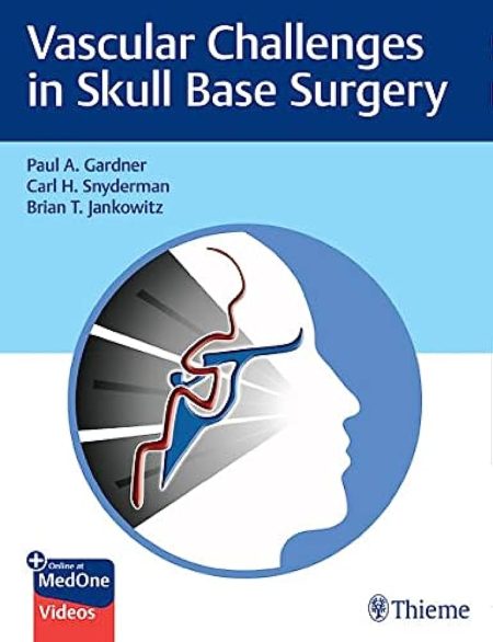 Vascular Challenges in Skull Base Surgery