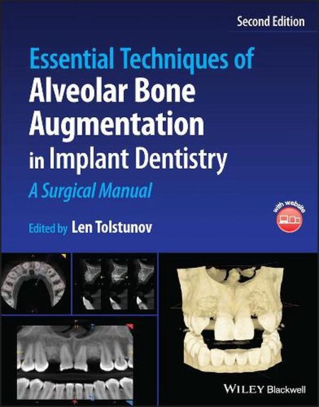 Essential Techniques of Alveolar Bone Augmentation in Implant Dentistry: A Surgical Manual, 2nd Edition