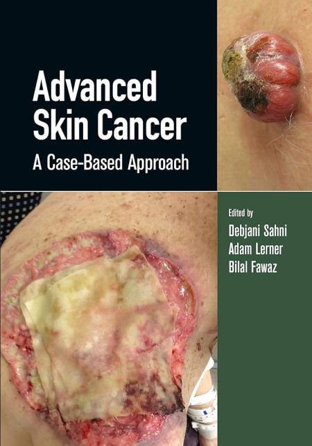 Advanced Skin Cancer. A Case-Based Approach 1st Edition