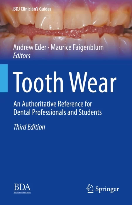 Tooth Wear. An Authoritative Reference for Dental Professionals and Students