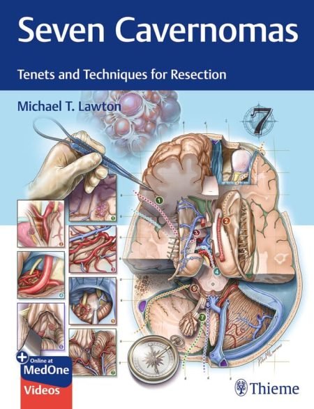 Seven Cavernomas. Tenets and Techniques for Resection